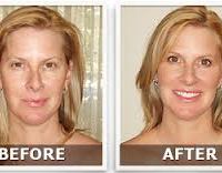 An Anti-Aging Cream Versus Botox Treatment
